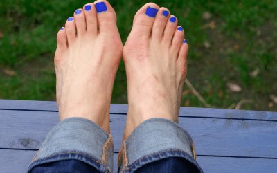 Bunions – The Not So Pretty Truth