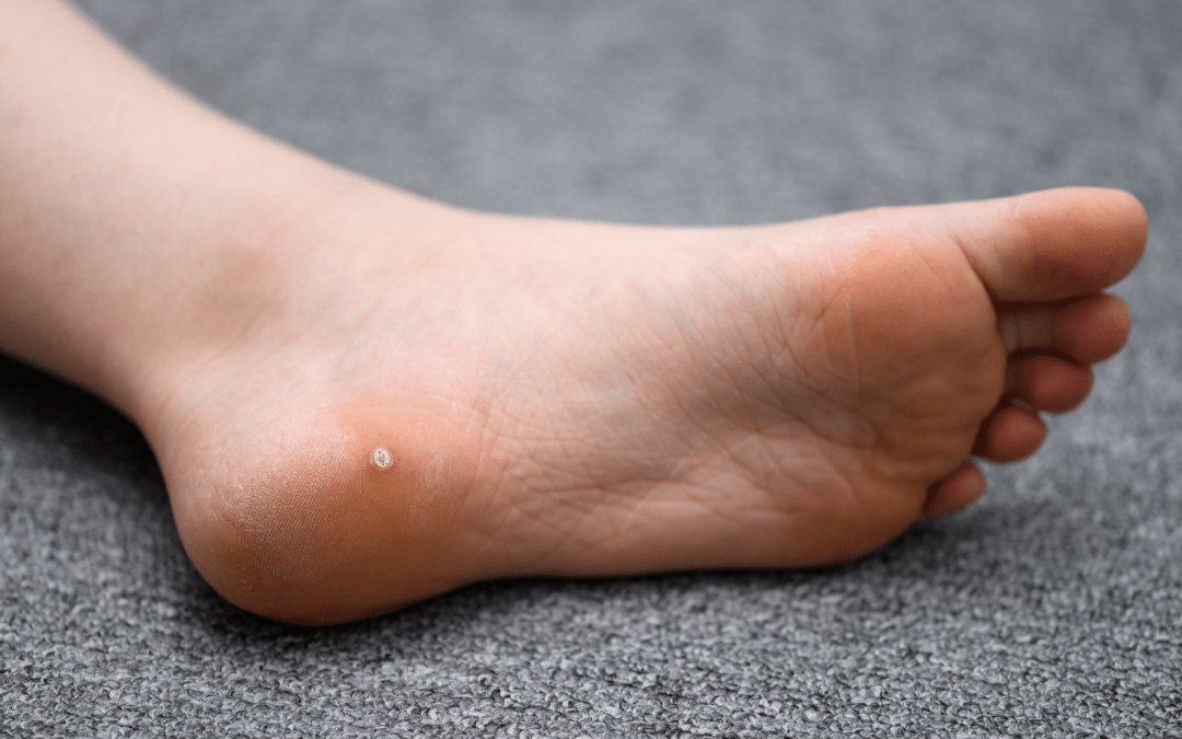 white foot with plantar wart on heel