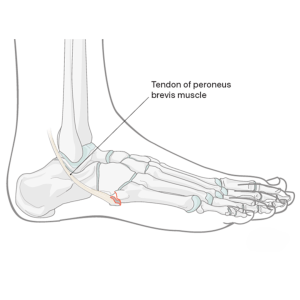 picture of skeletal foot showing peroneus brevis tendon and where a pseudo Jones fracture occurs