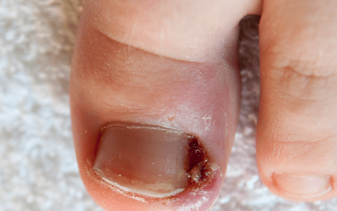 The Truth About Your Ingrown Toenail: Why Your Toe is Betraying You