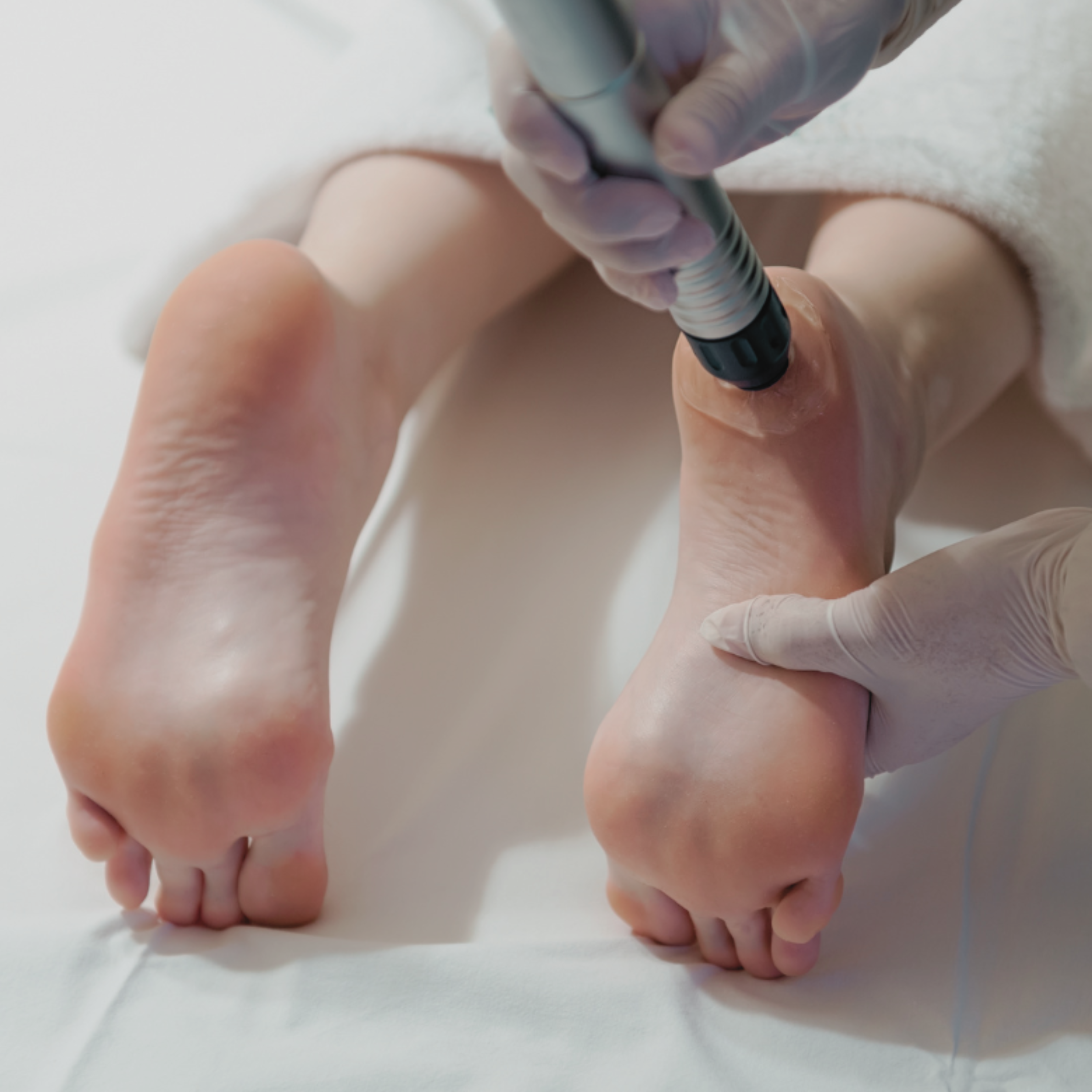 performing radial shockwave therapy on heel with plantar fasciitis