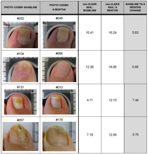 Lunula Nail Laser results for treatment of toenail fungus