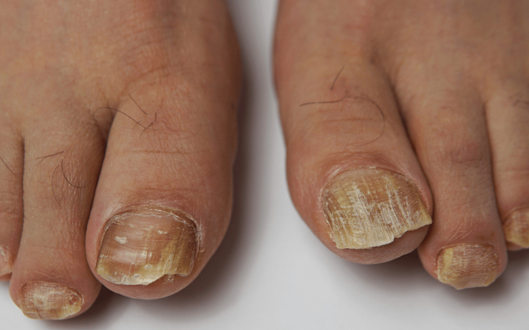 Thick Yellow Toenails: Is It Fungus or Something Else?