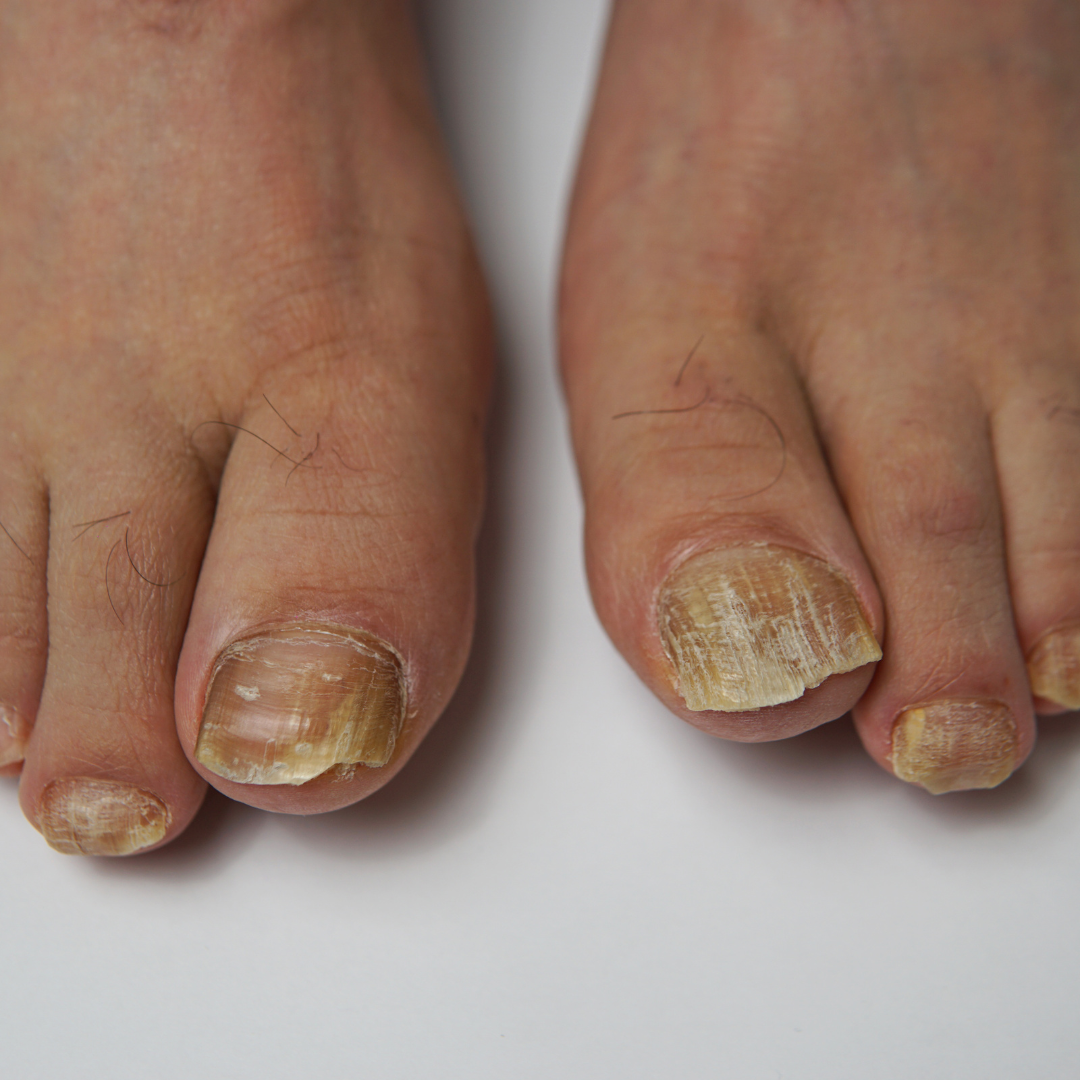 Feet shown with toenail fungus